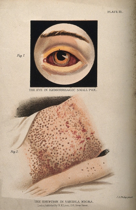 Bloodshot eye showing symptoms of haemorrhagic smallpox and variola nigra on the abdomen