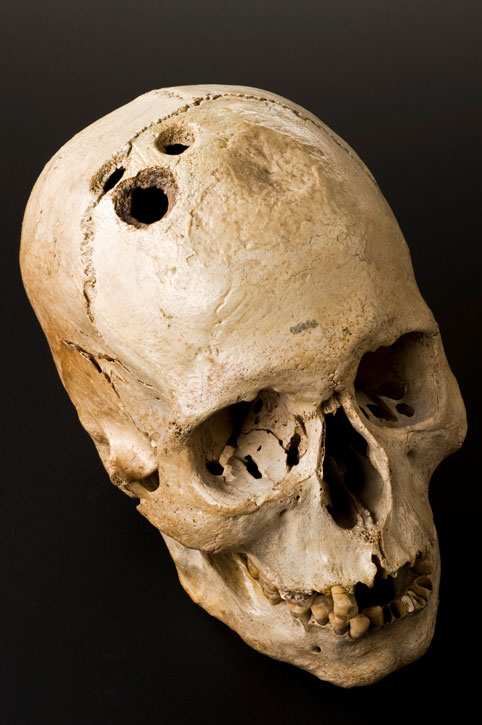 This skull shows four separate holes made by the ancient surgical process of trephination. They had clearly begun to heal, which suggests that although highly dangerous, the procedure was by no means fatal.