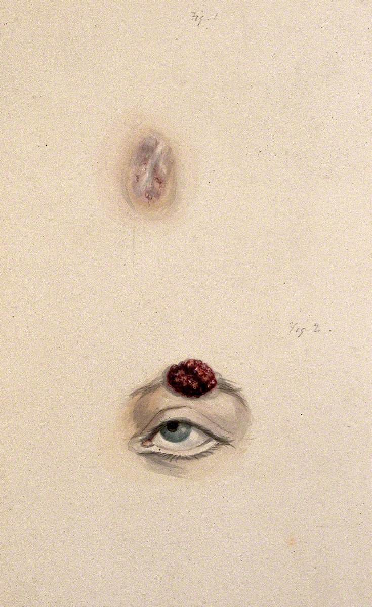 A Section of a Child's Diseased Forehead and a Child's Diseased Eyebrow, Numbered for Key