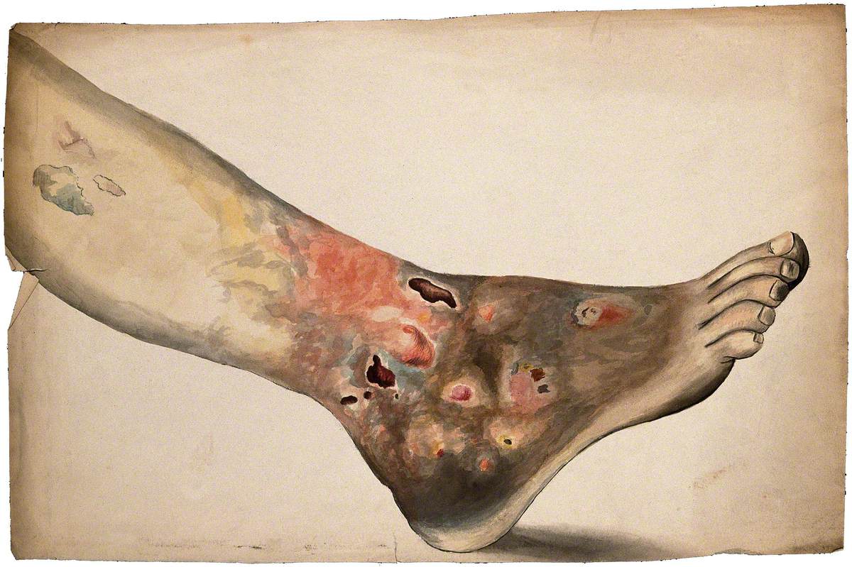 A Diseased Foot and Lower Leg