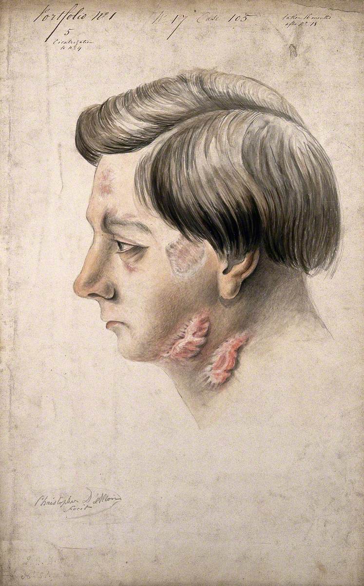 Head of a Man with a Severe Disease Affecting His Face and Neck