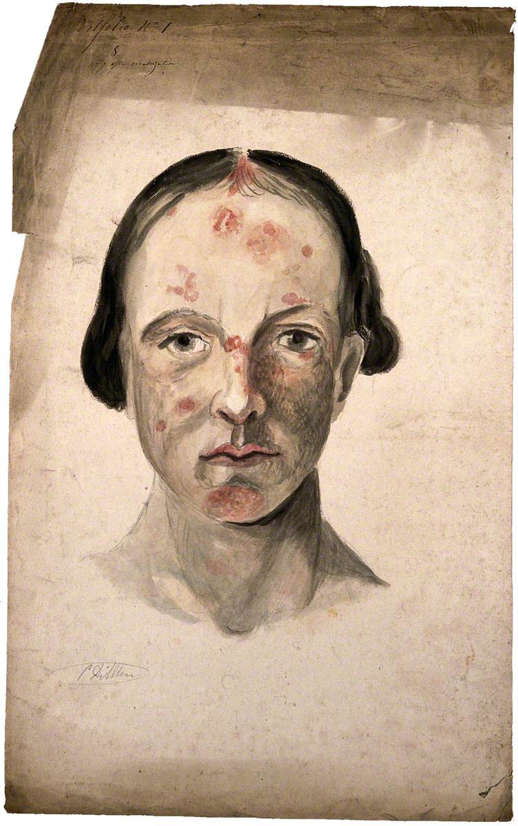 Head of a Woman with a Disease Affecting Her Face