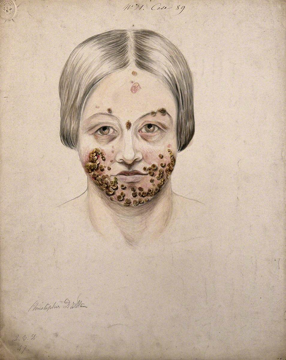 Head of a Woman with a Severe Disease Affecting Her Face