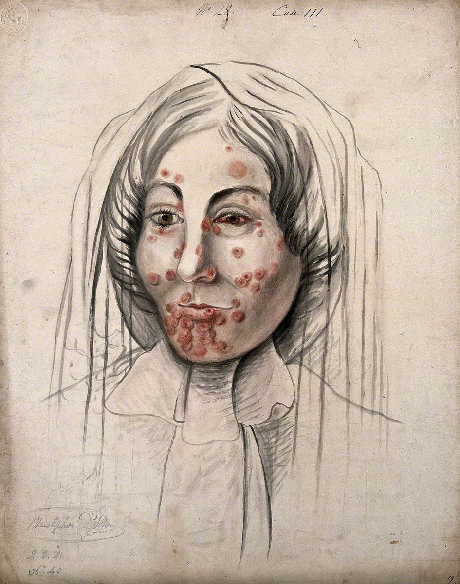 Head of a Woman with a Severe Disease Affecting Her Face