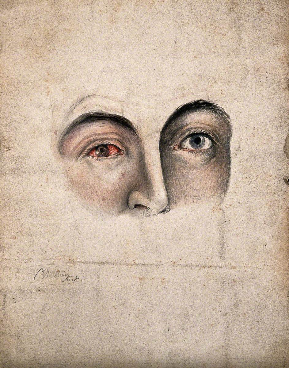 A Section of a Face (Eyes and Nose) with a Disease Affecting One Eye