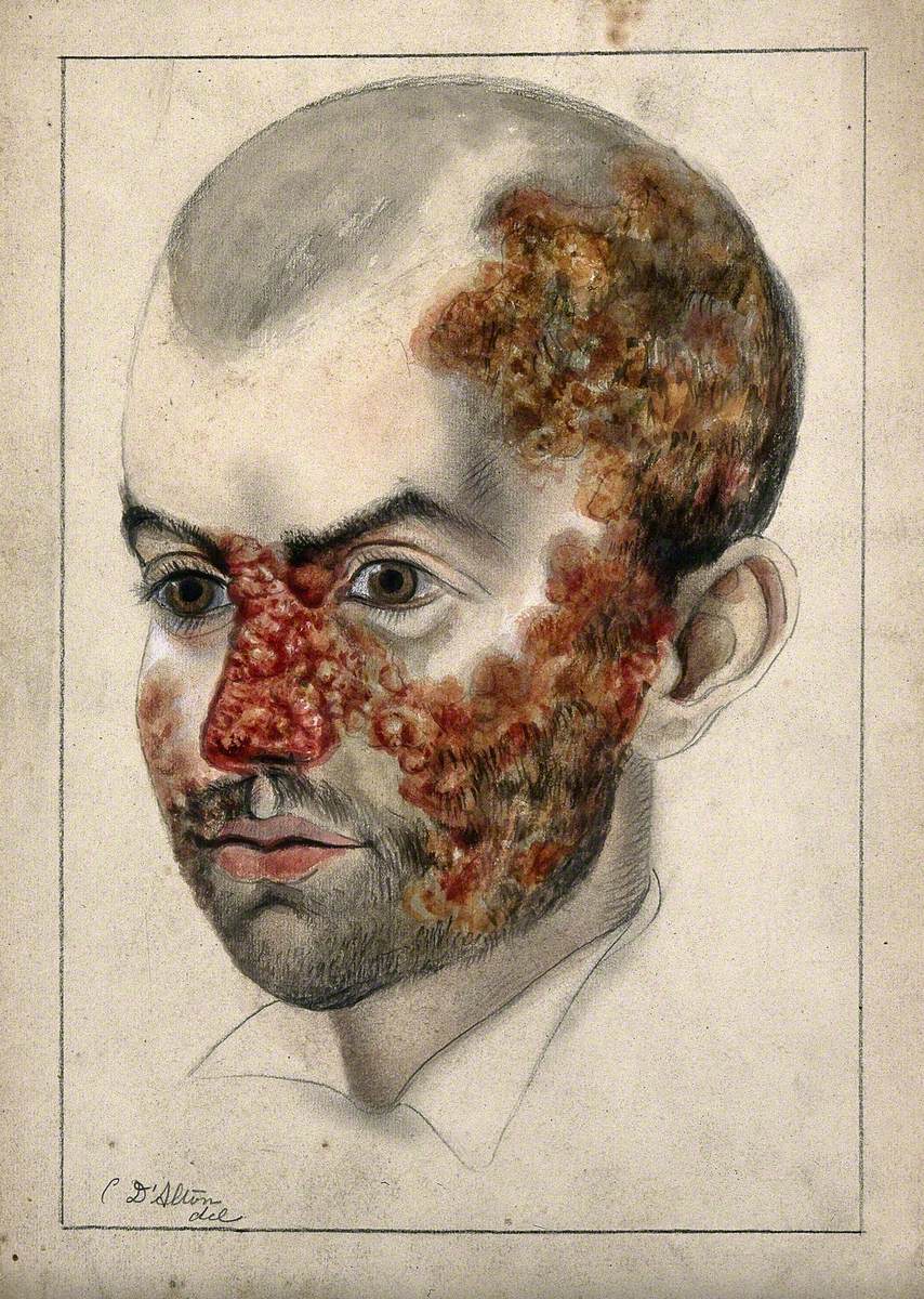 Head of a Man with a Severe Disease Affecting His Face and Scalp