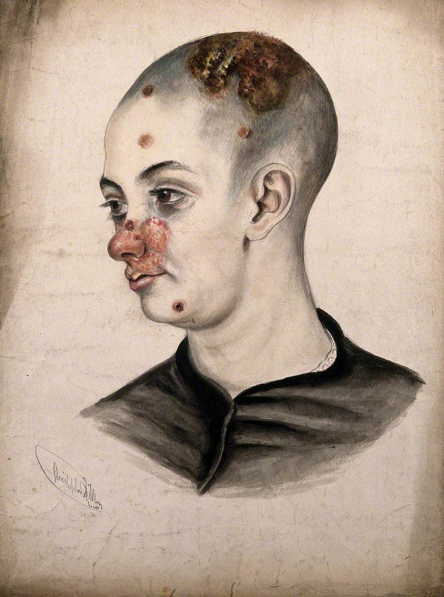 Head of a Young Woman with a Severe Disease Affecting Her Face and Scalp