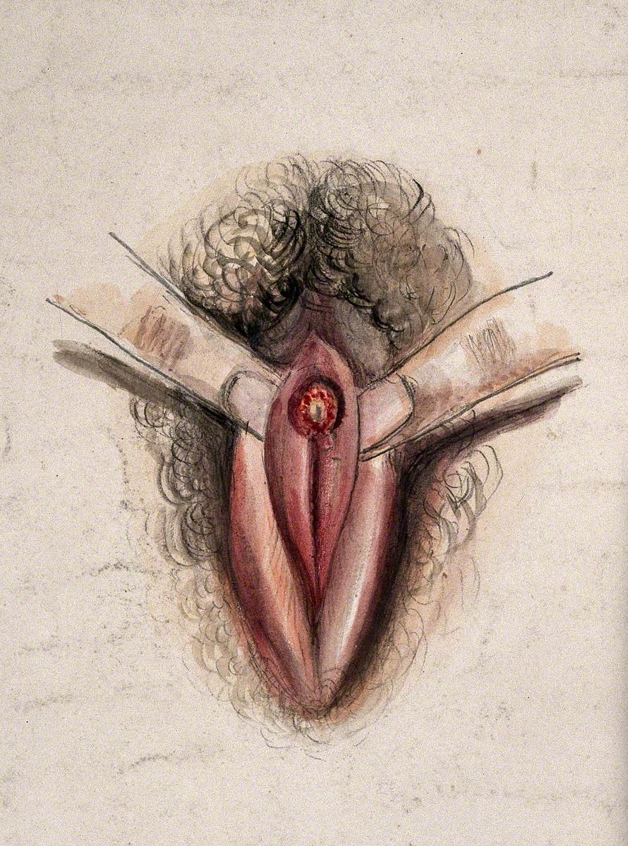 Female Genitalia Held Open by Two Fingers to Show an Area of Diseased Tissue