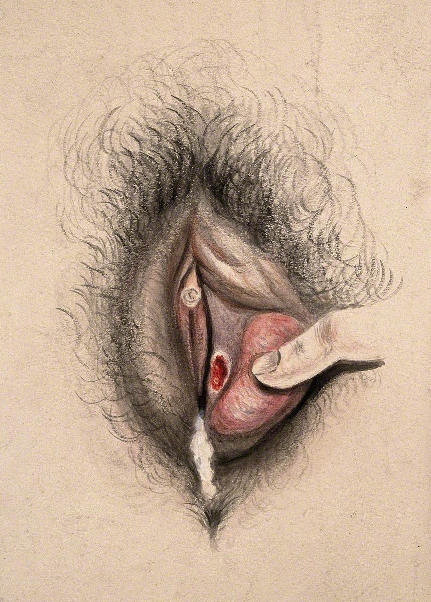 Female Genitalia Held Open by a Finger to Show an Area of Diseased Tissue