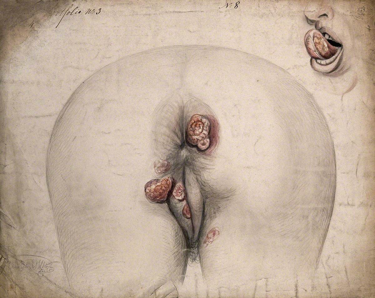 The Diseased Tissue around the Anus and Genitals of a Woman, as Seen from Behind; and a Detail of a Diseased Tongue