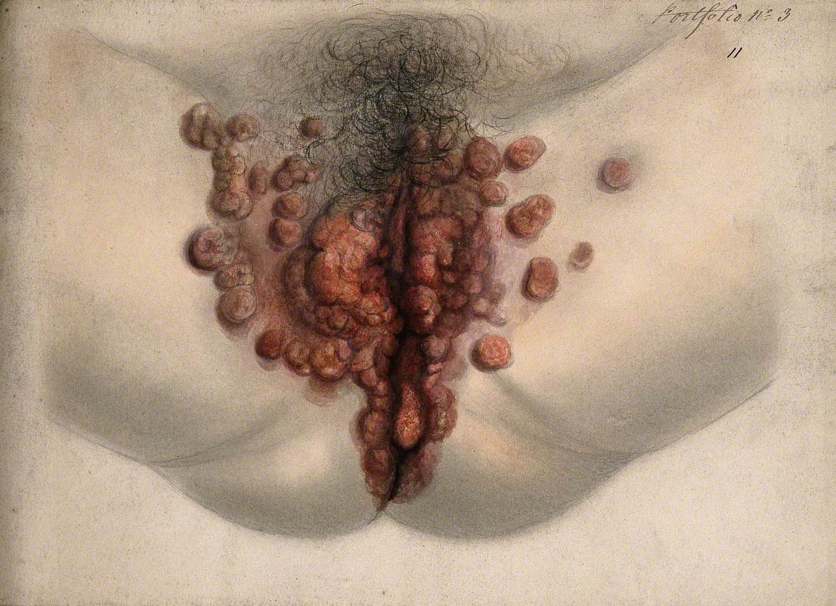 Female Genitalia Showing Severely Diseased Tissue