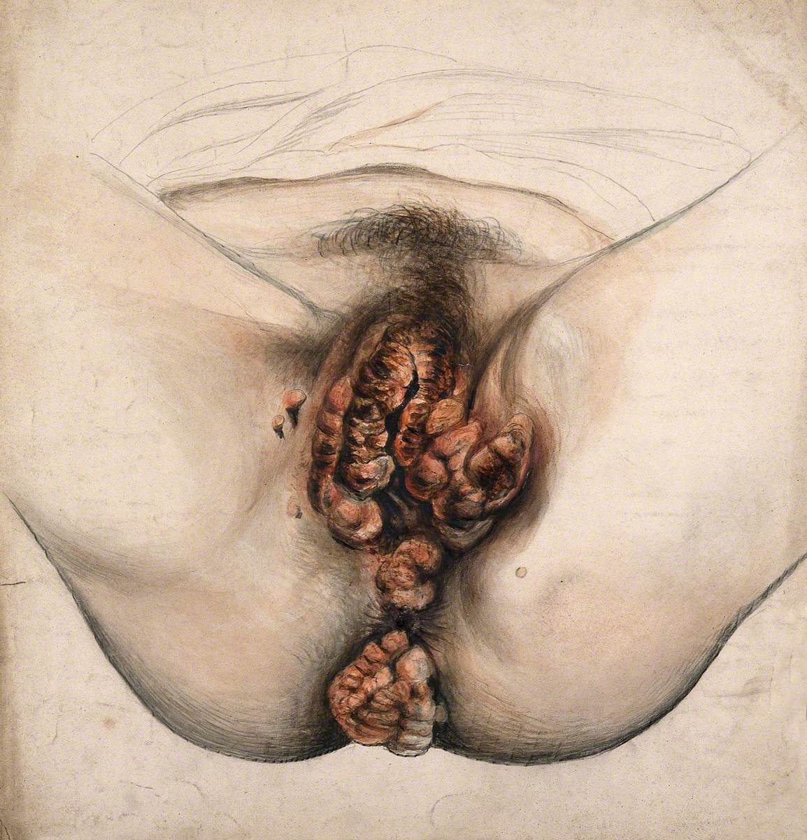 Female Genitalia Showing Severely Diseased Tissue from the Pubis to the Anus