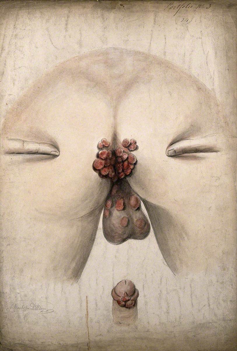 The Diseased Anus and Scrotum of a Man, as Seen from Behind, with Two Fingers on the Buttocks to Hold Them Apart; and a Detail of a Diseased Penis