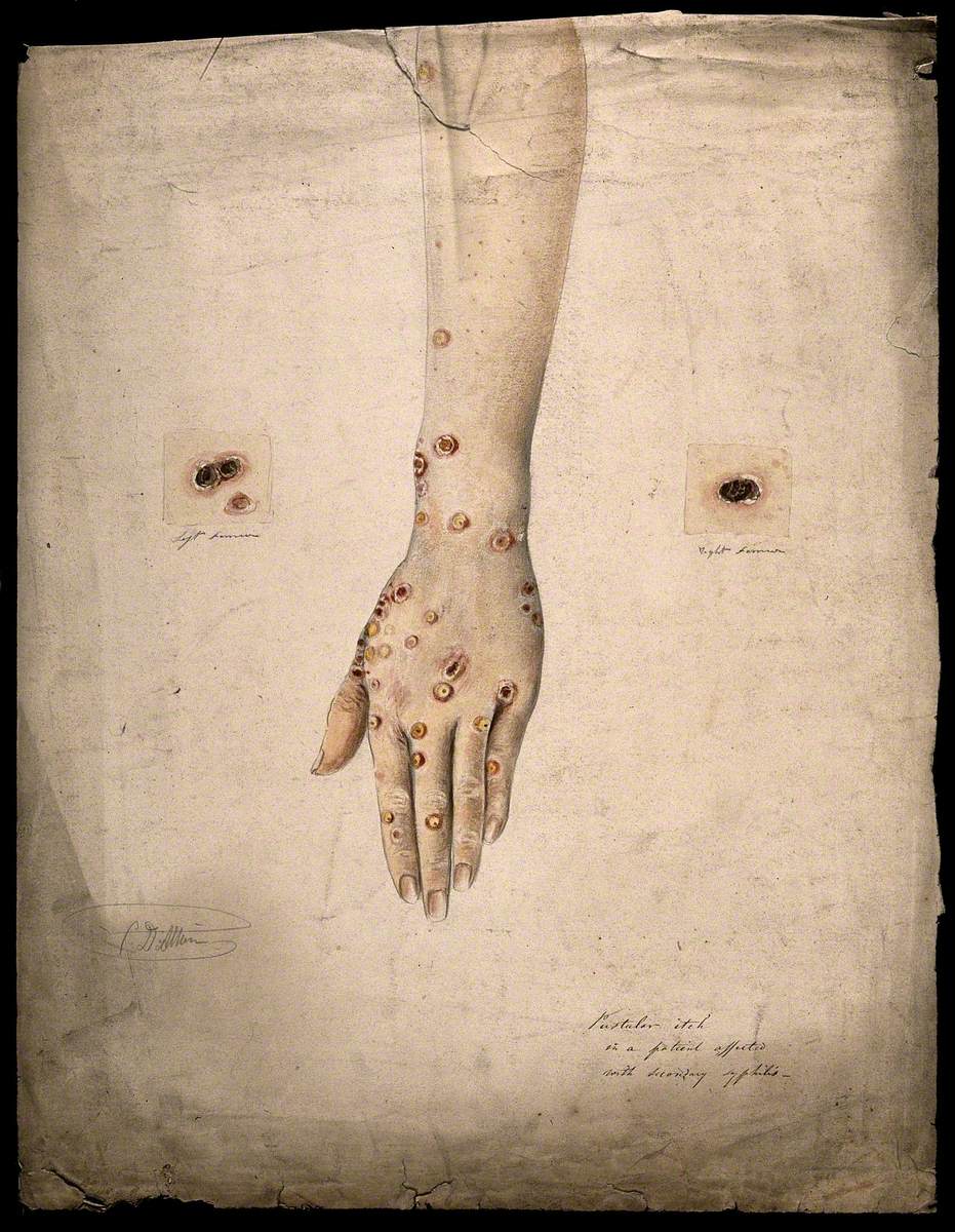 Sores and Pustules on the Hand and Arms of a Woman Suffering from Secondary Syphilis