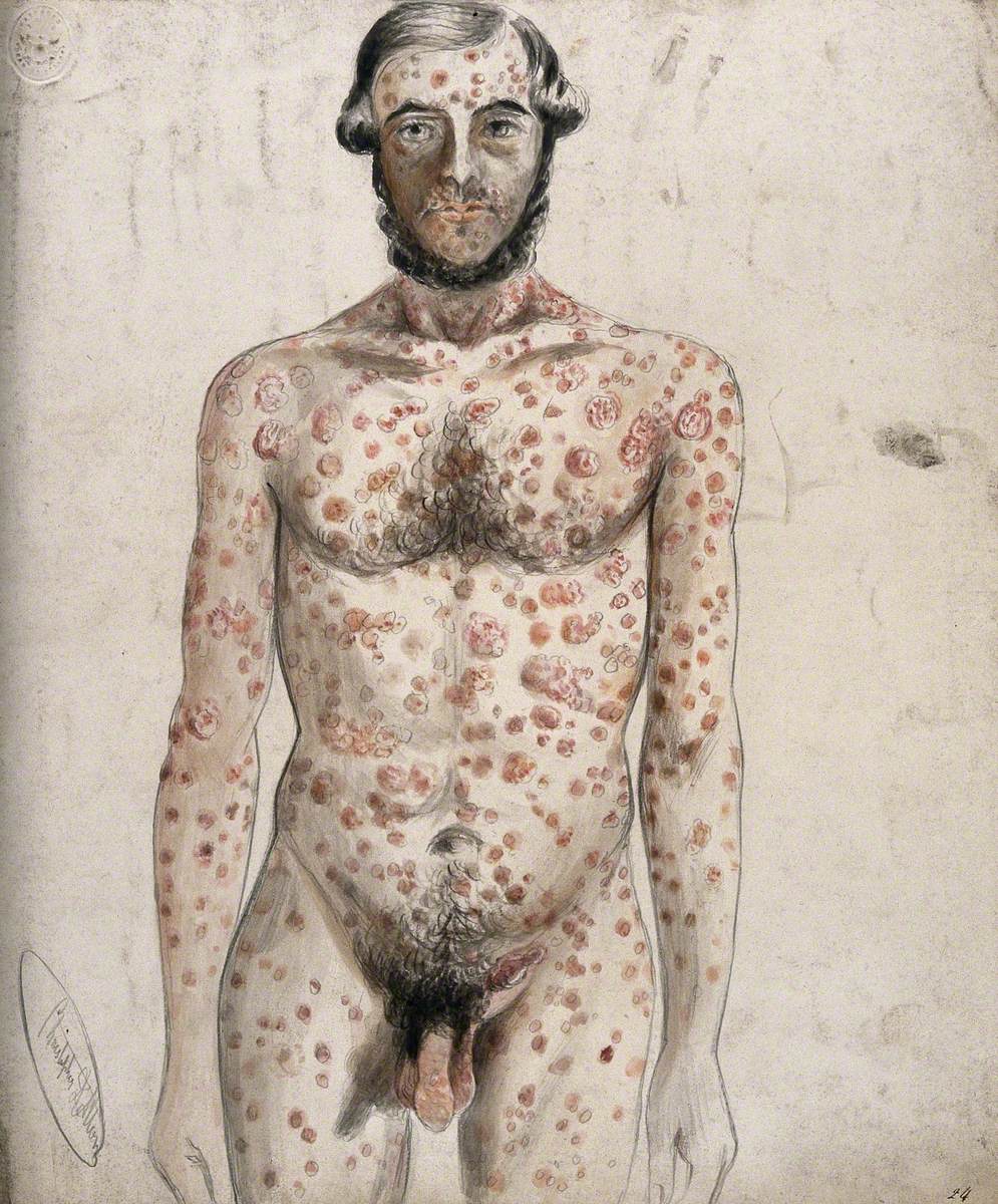 Sores and Abcesses (?) Covering the Face and Body of a Man