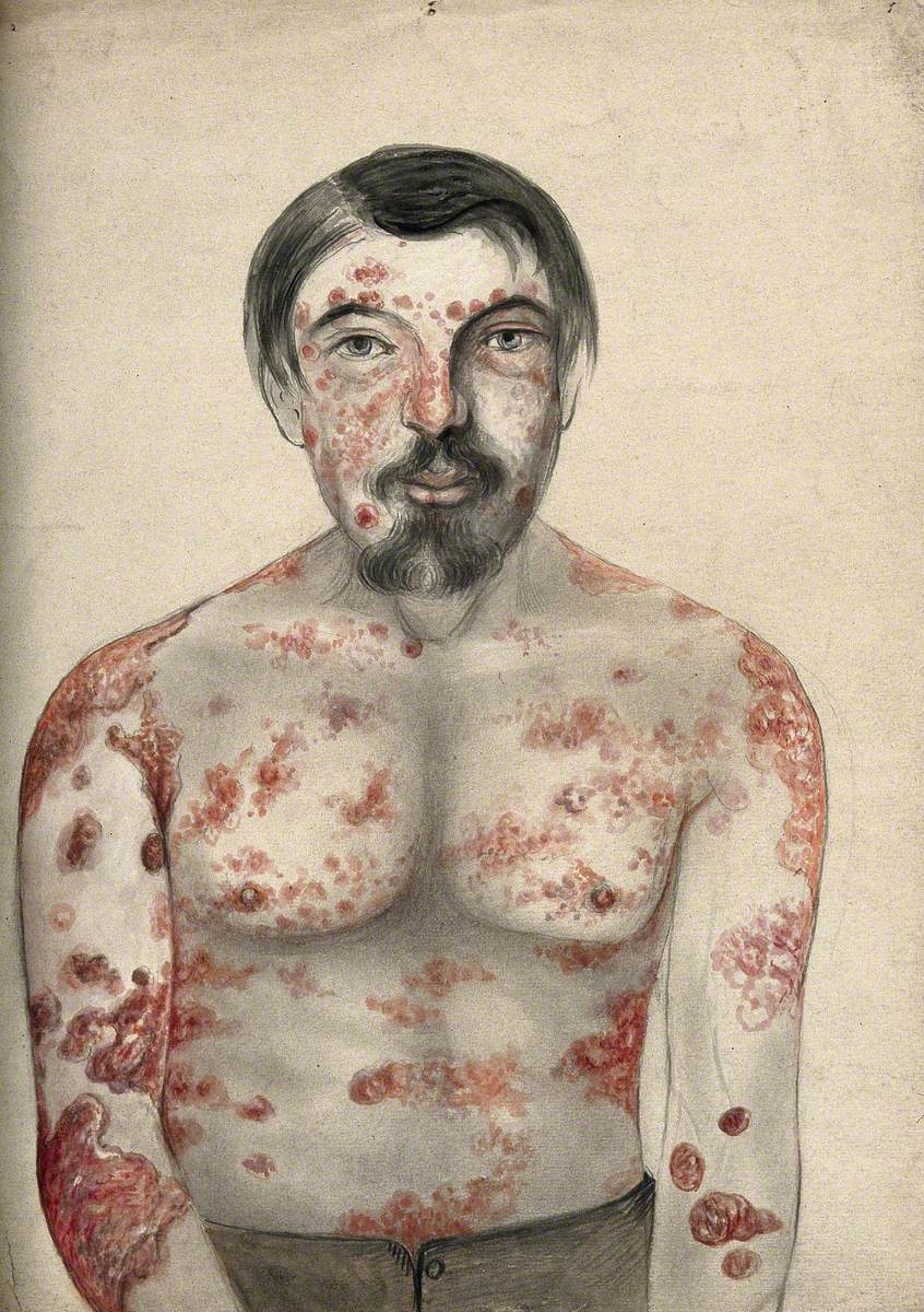 Diseased Tissue on the Face, Shoulders, Arms and Torso of a Man Suffering from Psoriasis and Possibly Syphilis