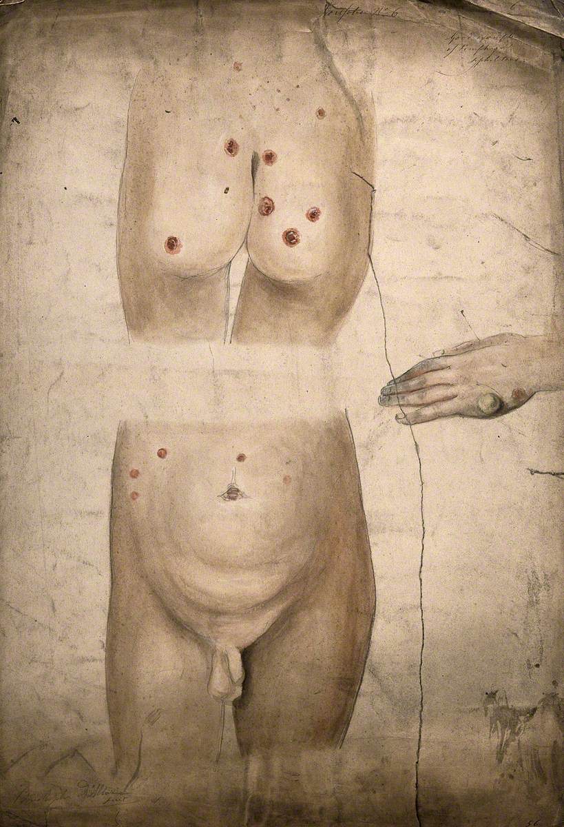 Sores and Abcesses (?) on the Buttocks and Abdomen of a Young Boy Suffering from Syphilis, with a Detail Showing a Large Boil or Abcess on the Boy's Hand