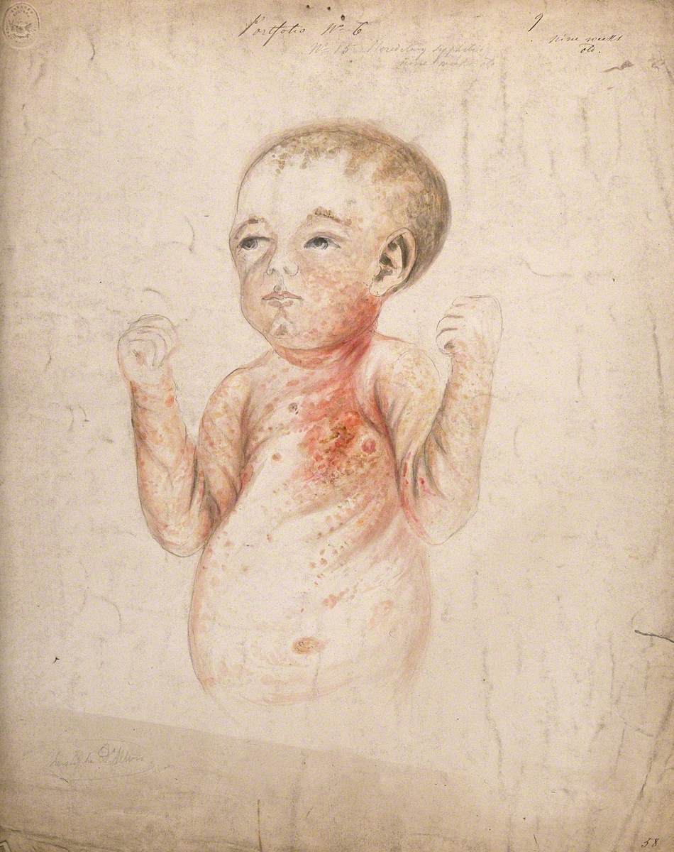A Nine-Week-Old Baby Girl with Diseased Skin on Her Face, Arms and Body, Displaying Symptoms of Hereditary Syphilis
