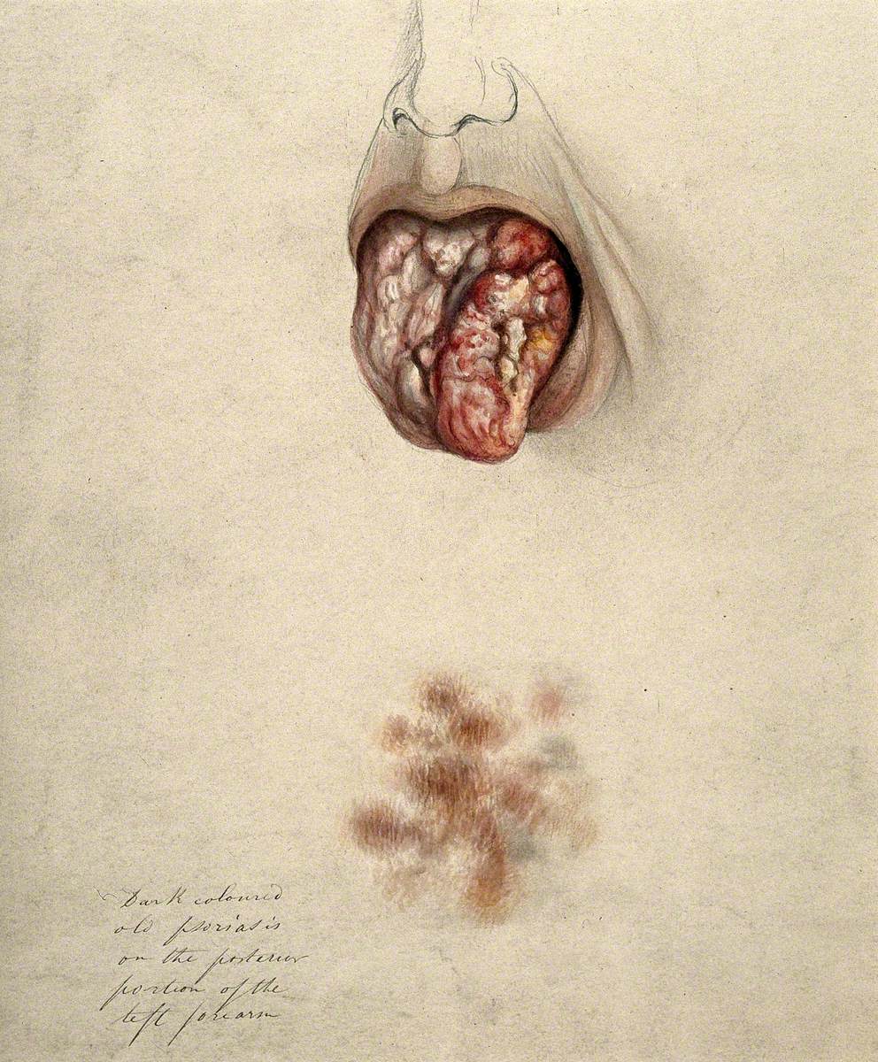 Diseased Tissue on the Tongue of a Man Suffering from Syphilis, with a Detail below Showing an Area of Psoriasis on the Man's Arm
