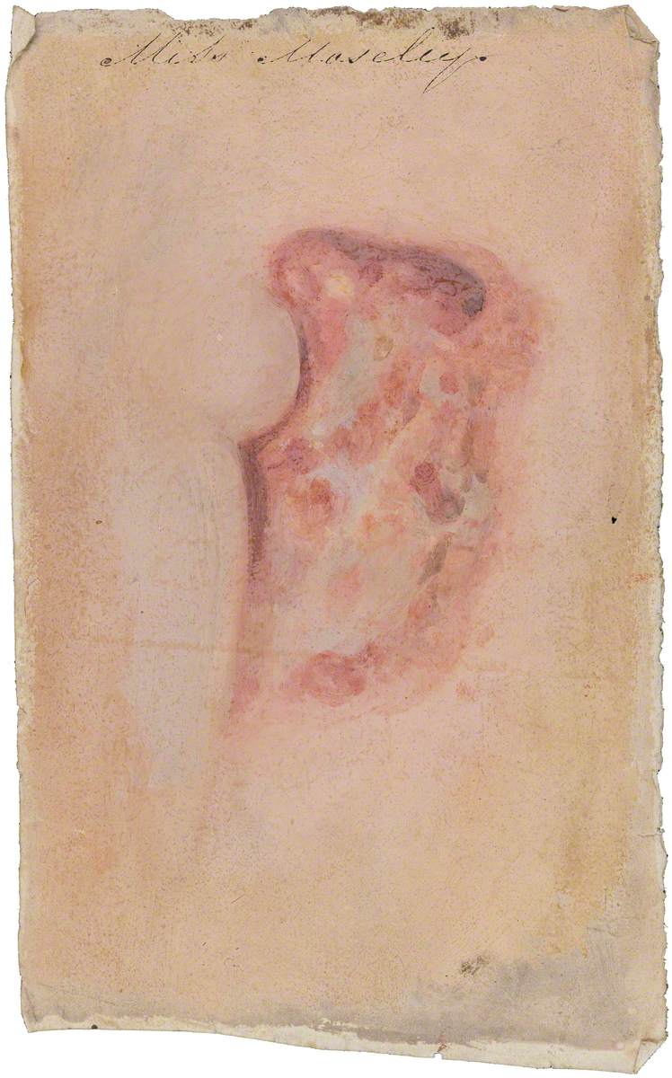 Miss Mosley, Afflicted with Breast Cancer: Detail of the Cancer