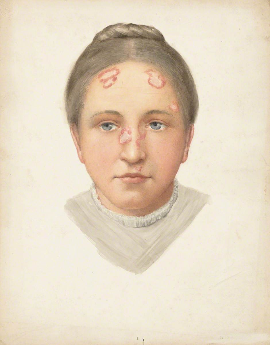 The Head of a Young Woman with Loss of Skin on Her Forehead and Nose
