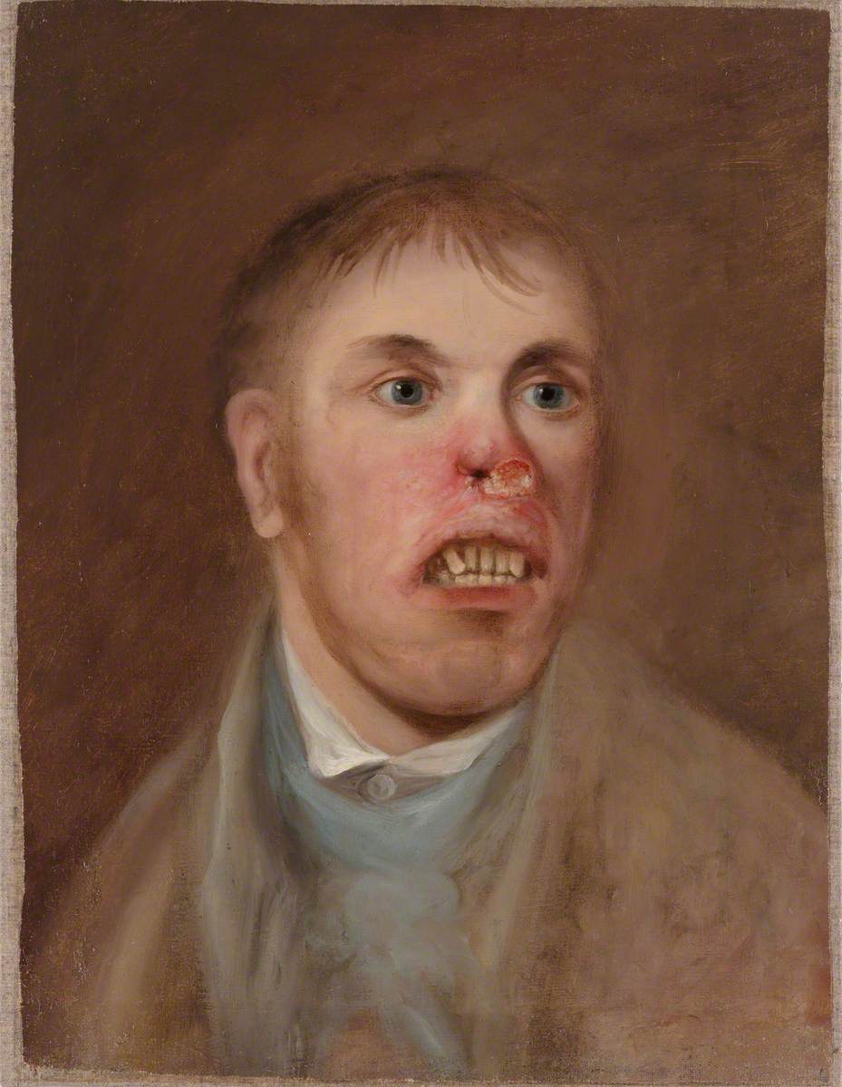 A Young Man, J. Kay, Afflicted with a Rodent Disease which Has Eaten Away Part of His Face