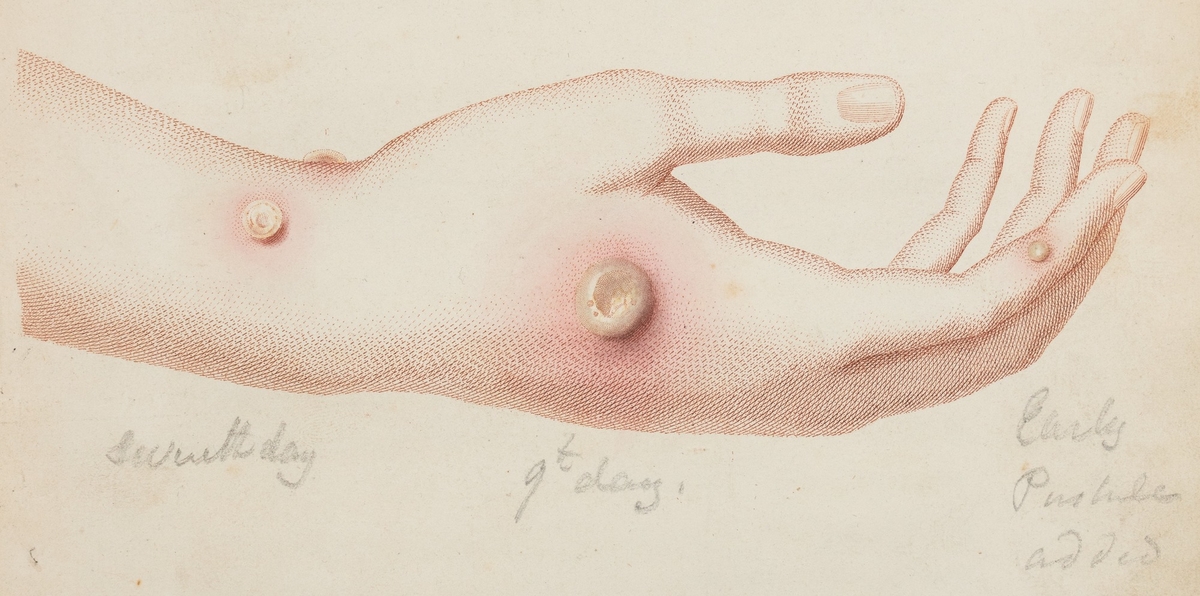 Smallpox Vaccination