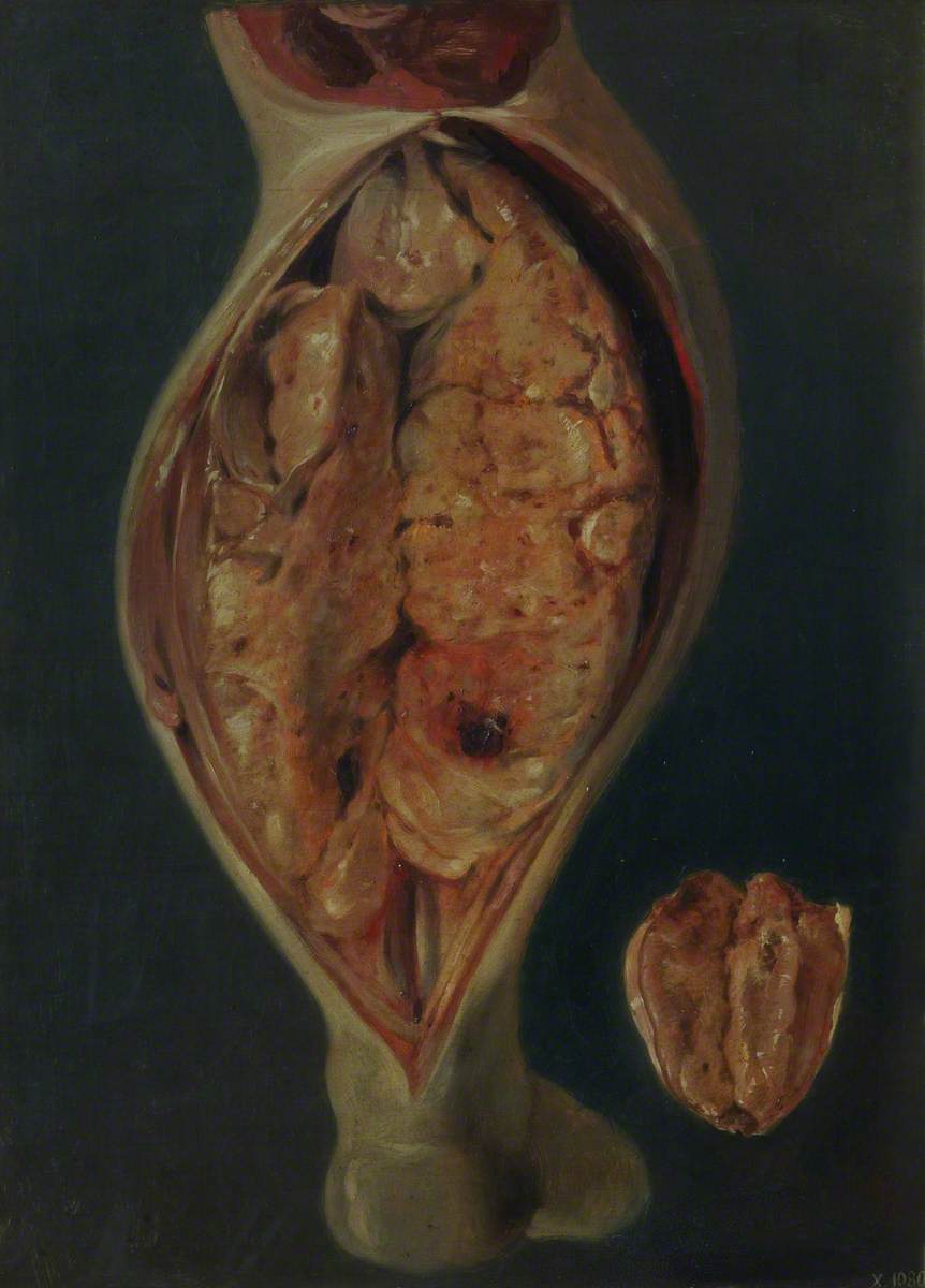 Dissected Calf Showing a Carcinoma