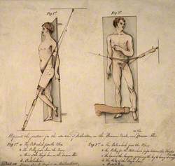 Two Human Figures Illustrating the Reduction of Dislocations of the Foramen Ovale and the Dorsum ILII