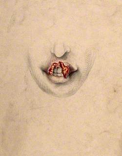 Severely Diseased Tissue on the Upper Lip of a Woman Suffering from Tertiary Syphilis