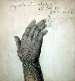 Rash of Pustules on the Hand of a Patient, Probably Suffering from Smallpox