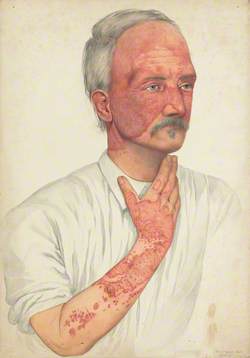 A Man with Disease Designated as Lupus Erythematosus