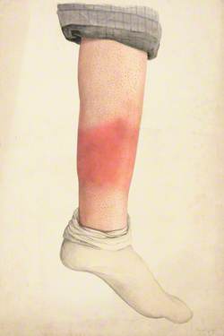 The Shin of a Boy with a Rash; Rolled Trouser Leg and Sock in Place