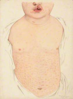 A Boy with a Congenital Deformity of the Mouth and a Rash on the Trunk