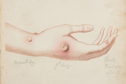 Smallpox Vaccination