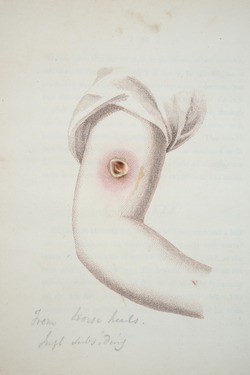 Smallpox Vaccination