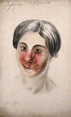 Head of a Woman with a Severe Disease Affecting Her Face