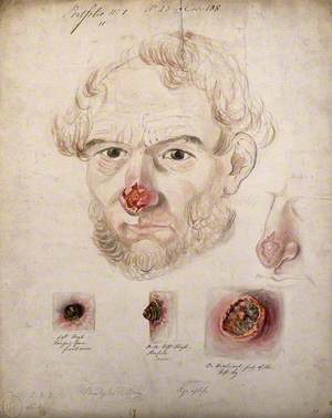 Head of a Man with a Severe Disease Affecting His Nose; a Detail of the Nose, and Three Details of Sores on His Thigh