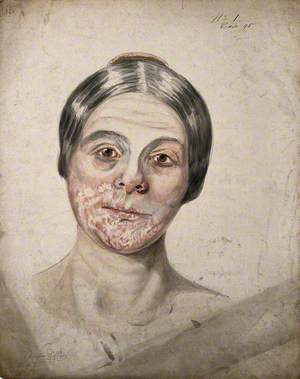 Head of a Woman with a Severe Disease Affecting Her Face