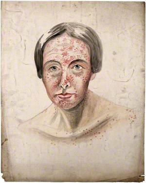 Head of a Woman with a Severe Disease Affecting Her Face and Shoulders