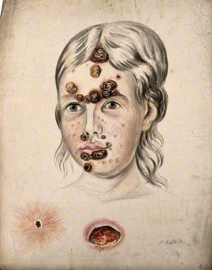 Head of a Woman with a Severe Disease Affecting Her Face; and Two Details of Sores
