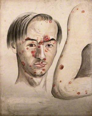 Head of a Man with a Severe Disease Affecting His Face; and a Section of Diseased Arm