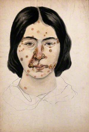 Head of a Woman with a Severe Disease Affecting Her Face