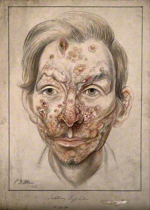 Head of a Man with Syphilitic Lesions Affecting His Face