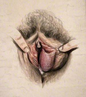 Female Genitalia Held Open by Two Fingers to Show an Area of Diseased Tissue