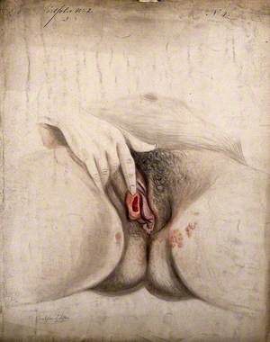 Female Genitalia Held Open by the Hand to Show Diseased Tissue, with Clusters of Sores at the Top of the Thighs to Each Side