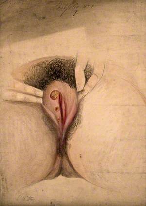 Female Genitalia Held Open by the Fingers to Show an Area of Diseased Tissue