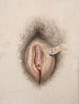 Female Genitalia Held Open by a Finger to Show Diseased Tissue