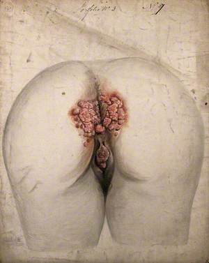 The Diseased Tissue around the Anus and Genitals of a Woman, as Seen from Behind