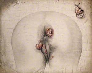 The Diseased Tissue around the Anus and Genitals of a Woman, as Seen from Behind; and a Detail of a Diseased Tongue